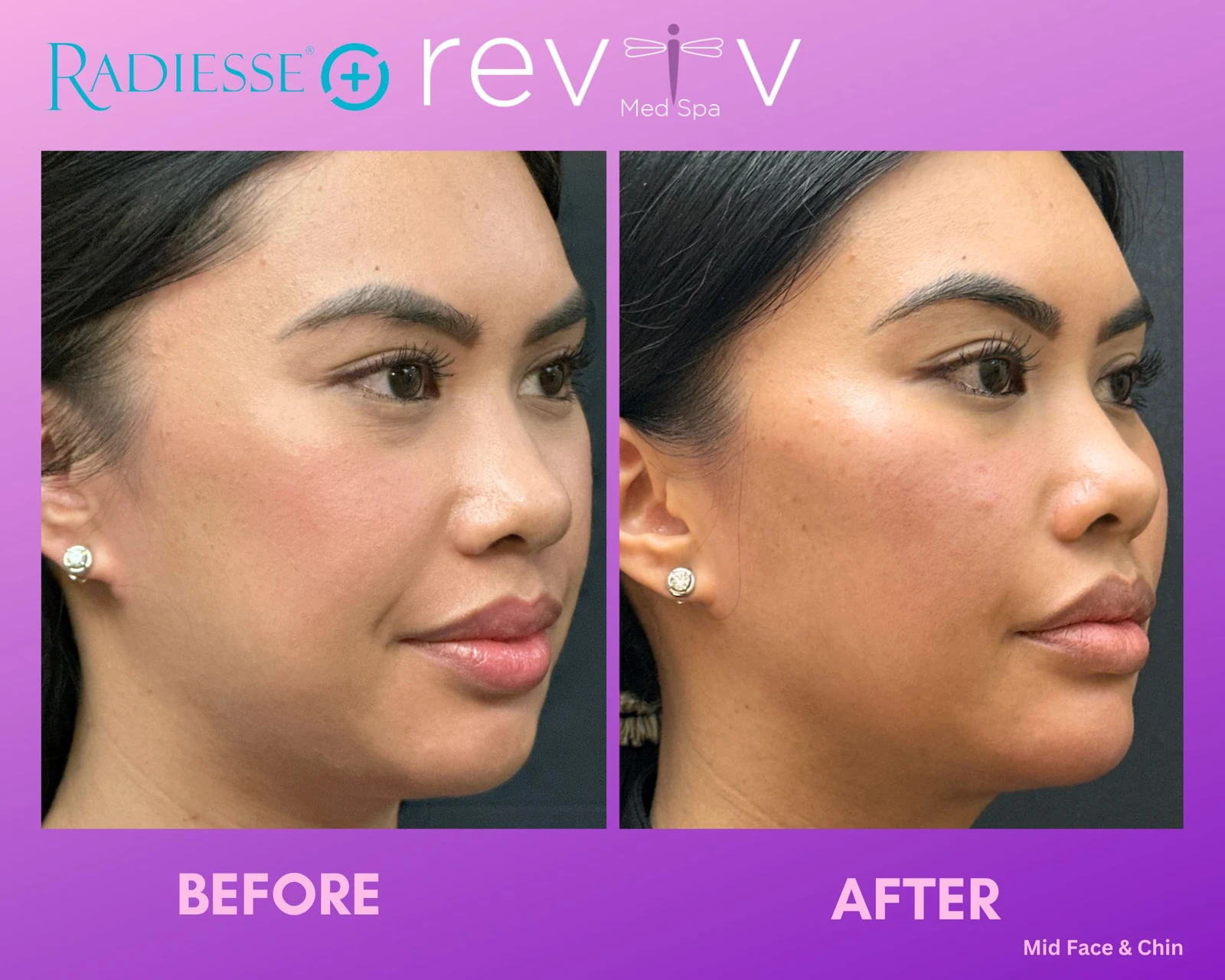 Reviv patient — Dermal Fillers (undefined)