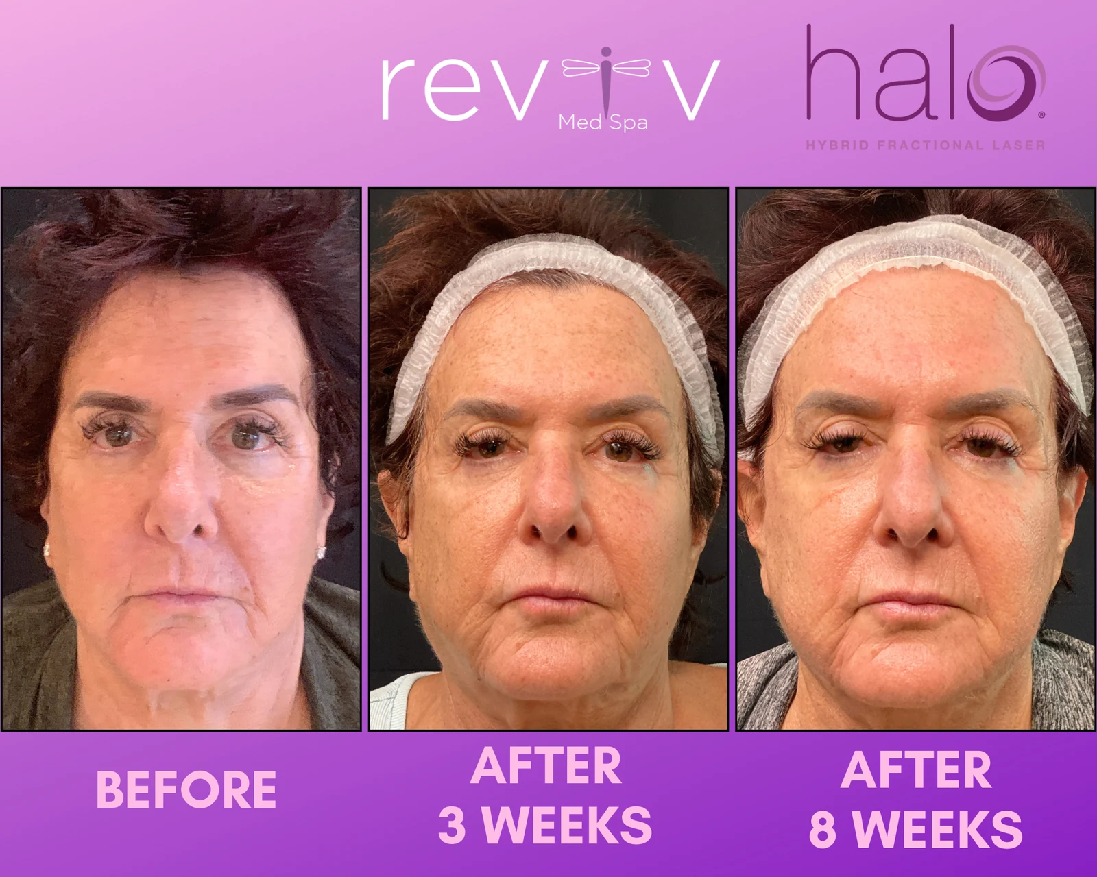 Reviv patient — Halo (undefined)