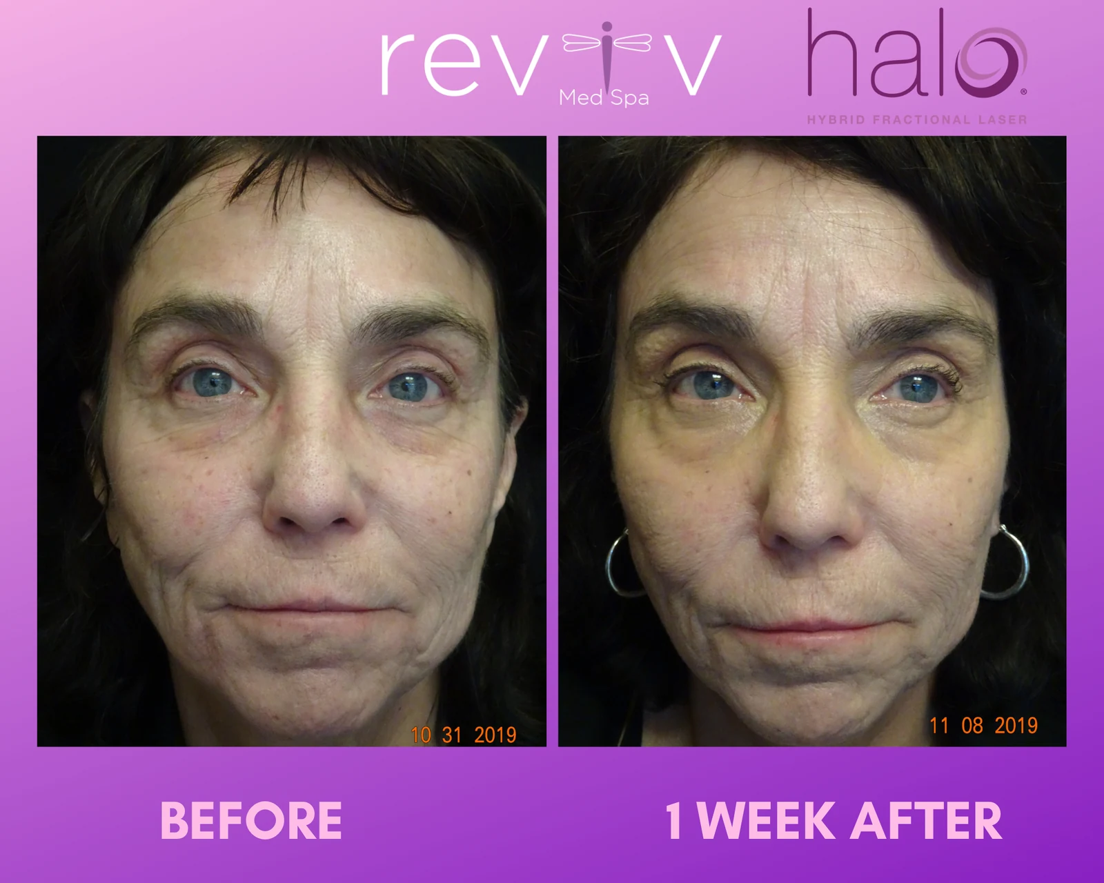 Reviv patient — Halo (undefined)