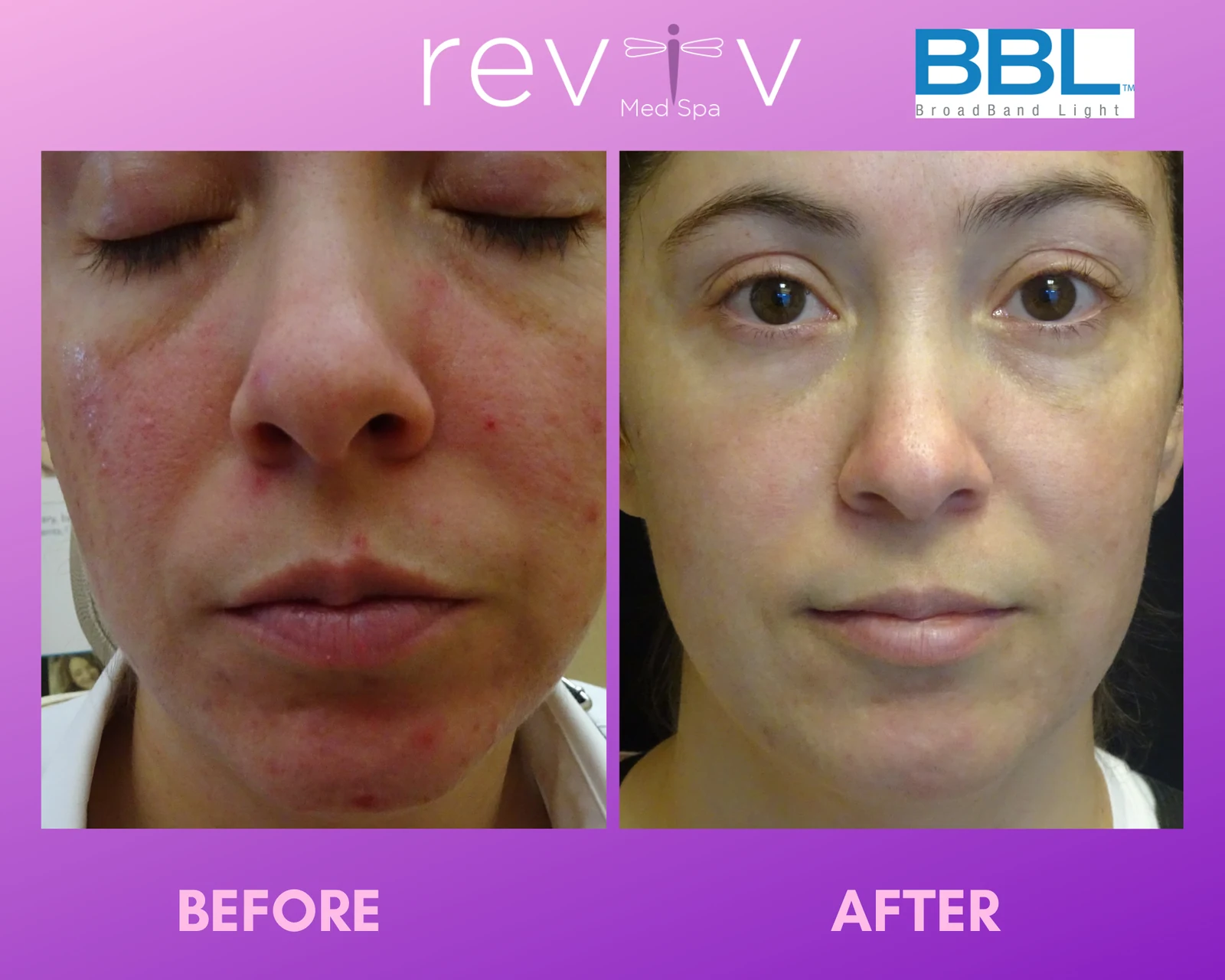 Reviv patient — BBL Hero (undefined)