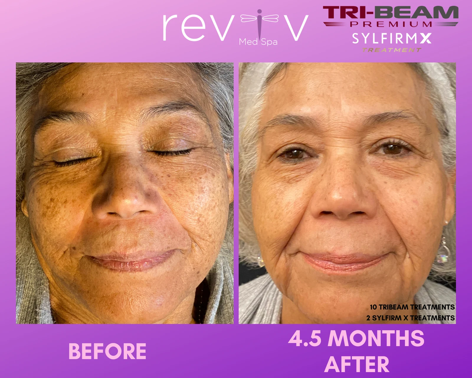 Reviv patient — Sylfirm + TriBeam (undefined)