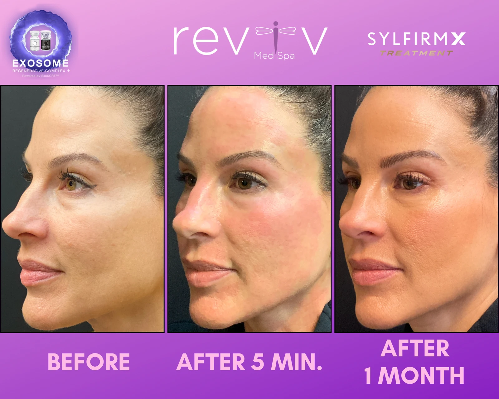 Reviv patient — Sylfirm X (undefined)