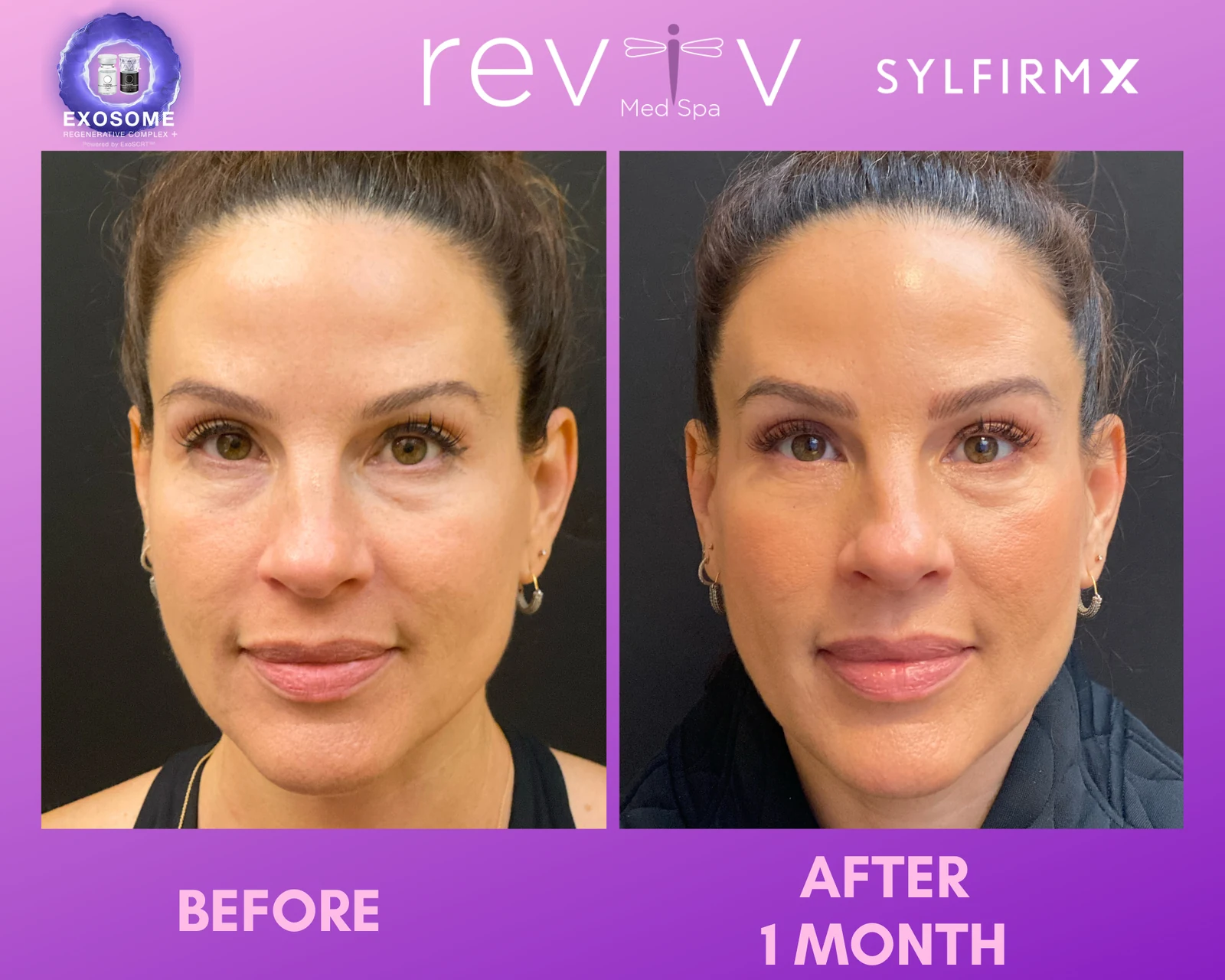 Reviv patient — Sylfirm X (undefined)