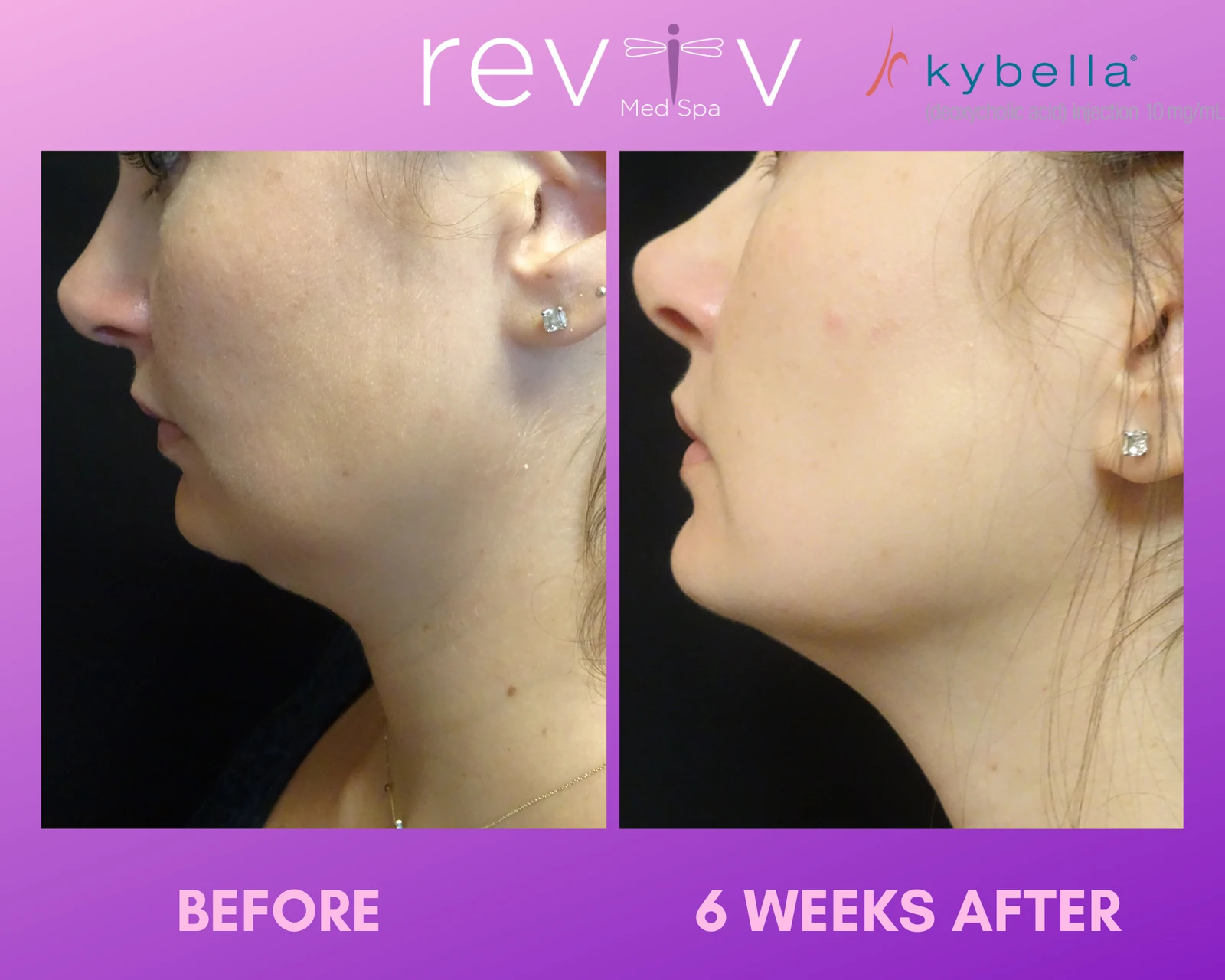 Reviv patient — Kybella (undefined)