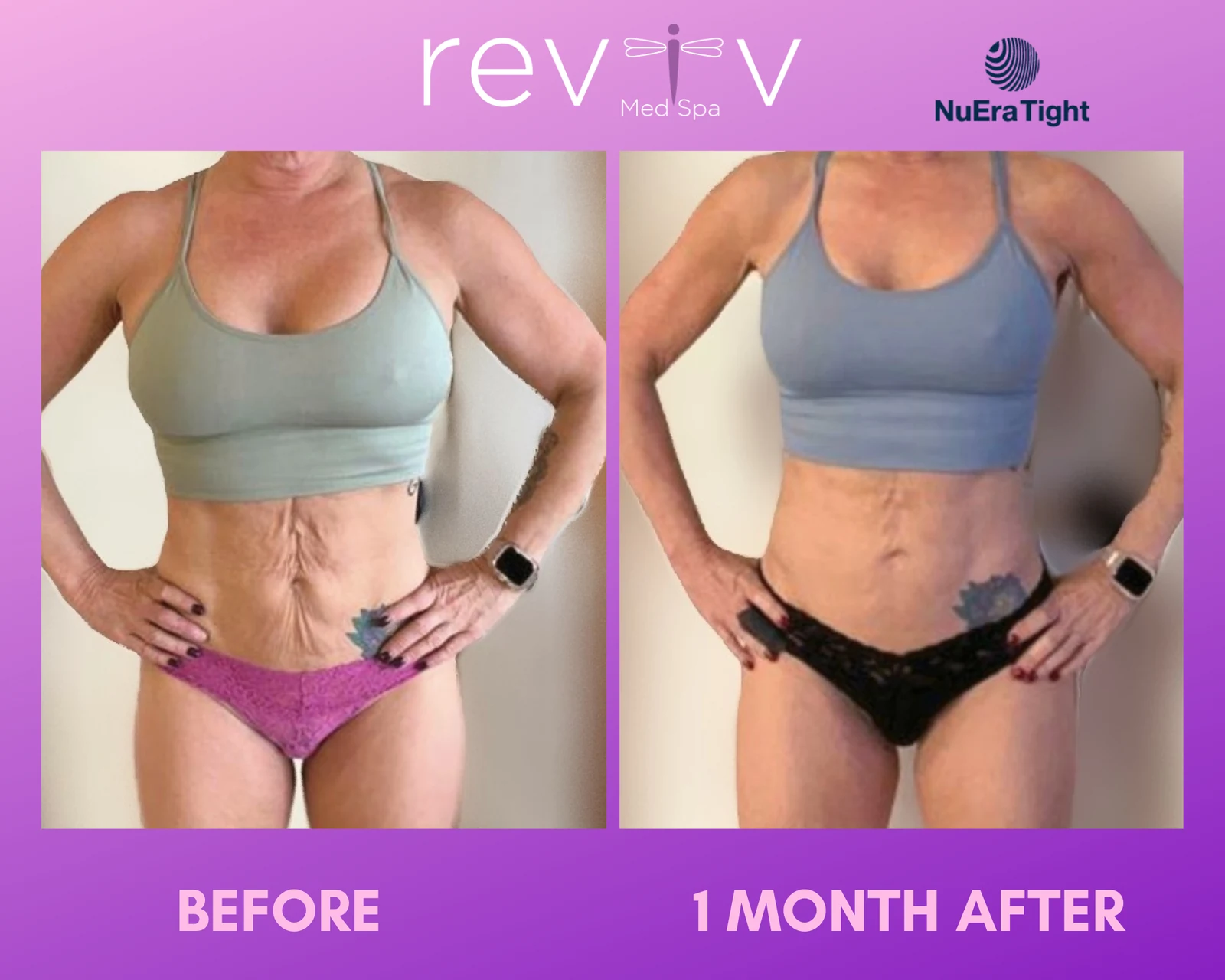 Reviv patient — NuEra Tight RF (undefined)