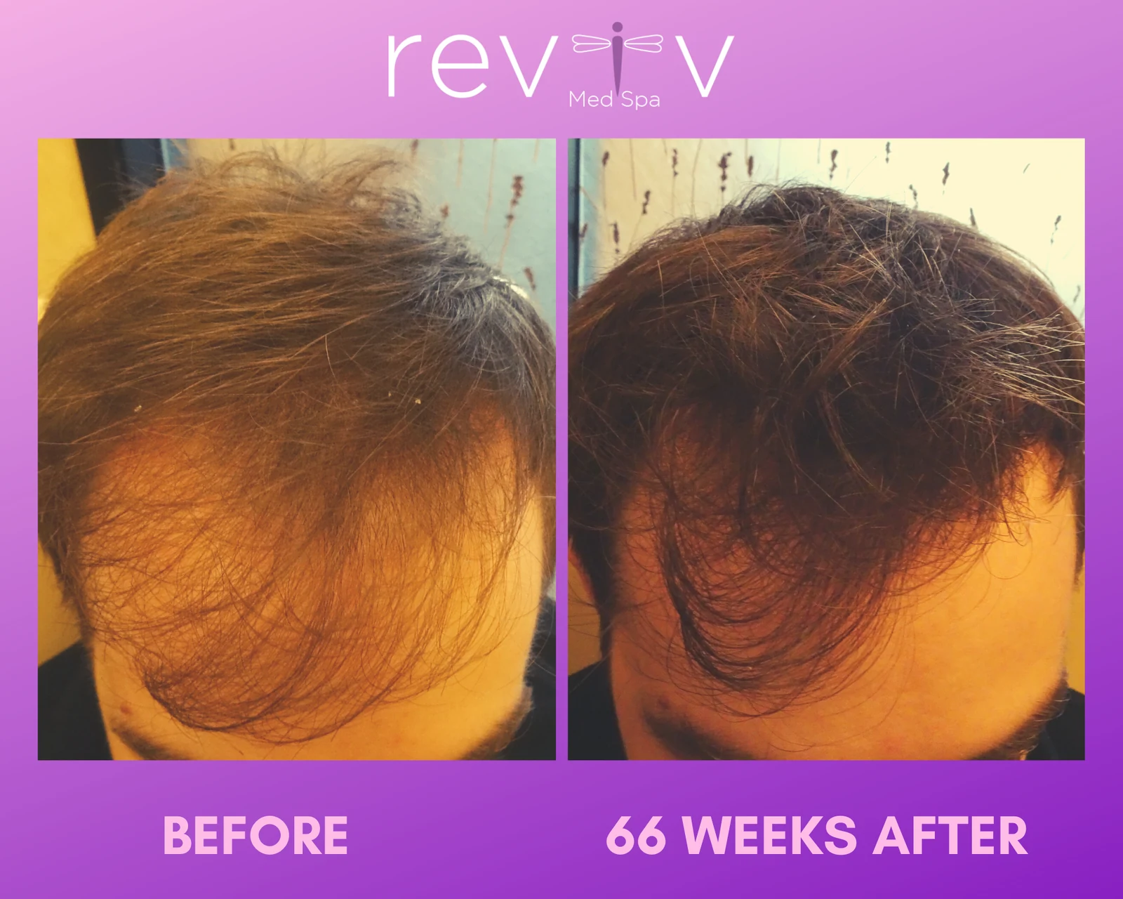 Reviv patient — PRP Hair (undefined)
