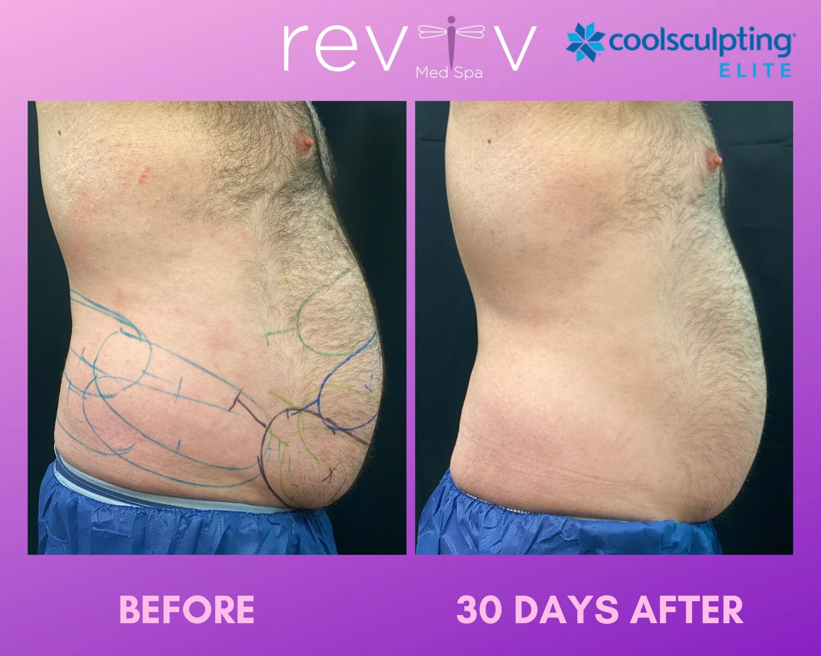 Reviv patient — CoolSculpting Elite (undefined)