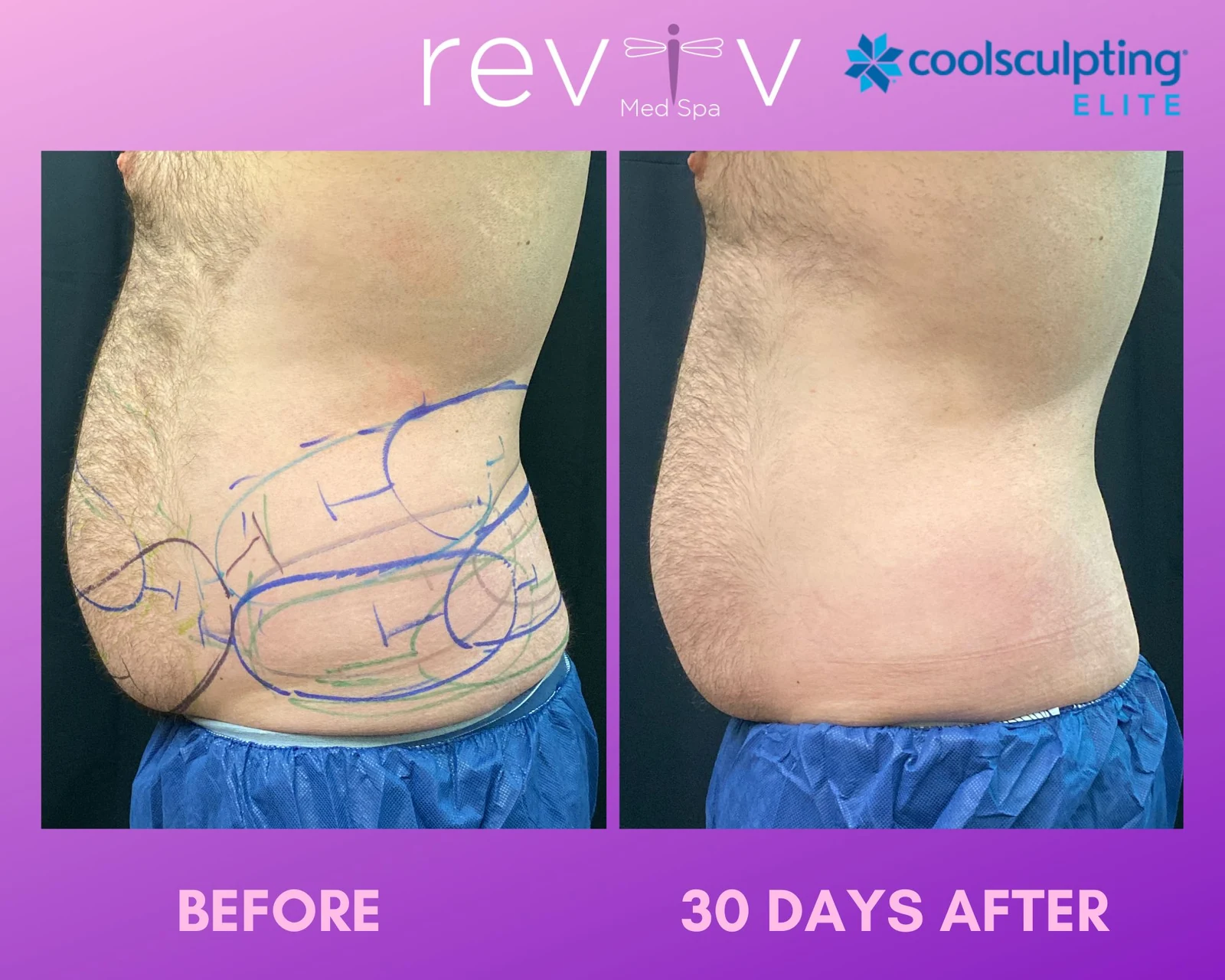 Reviv patient — CoolSculpting Elite (undefined)