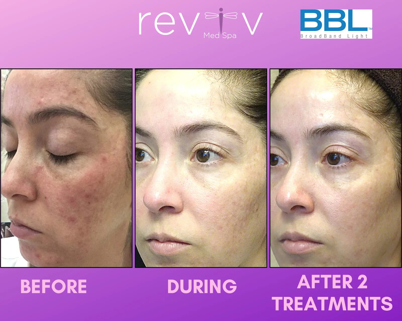 Reviv patient — BBL Hero (undefined)
