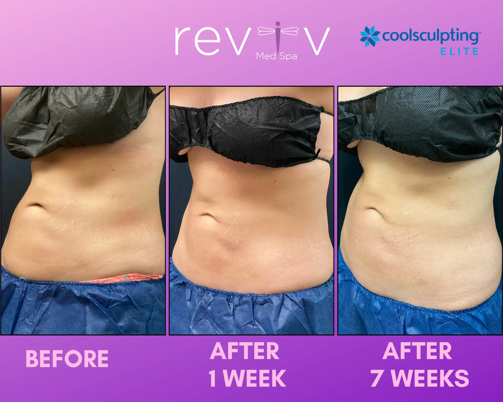Reviv patient — CoolSculpting Elite (undefined)