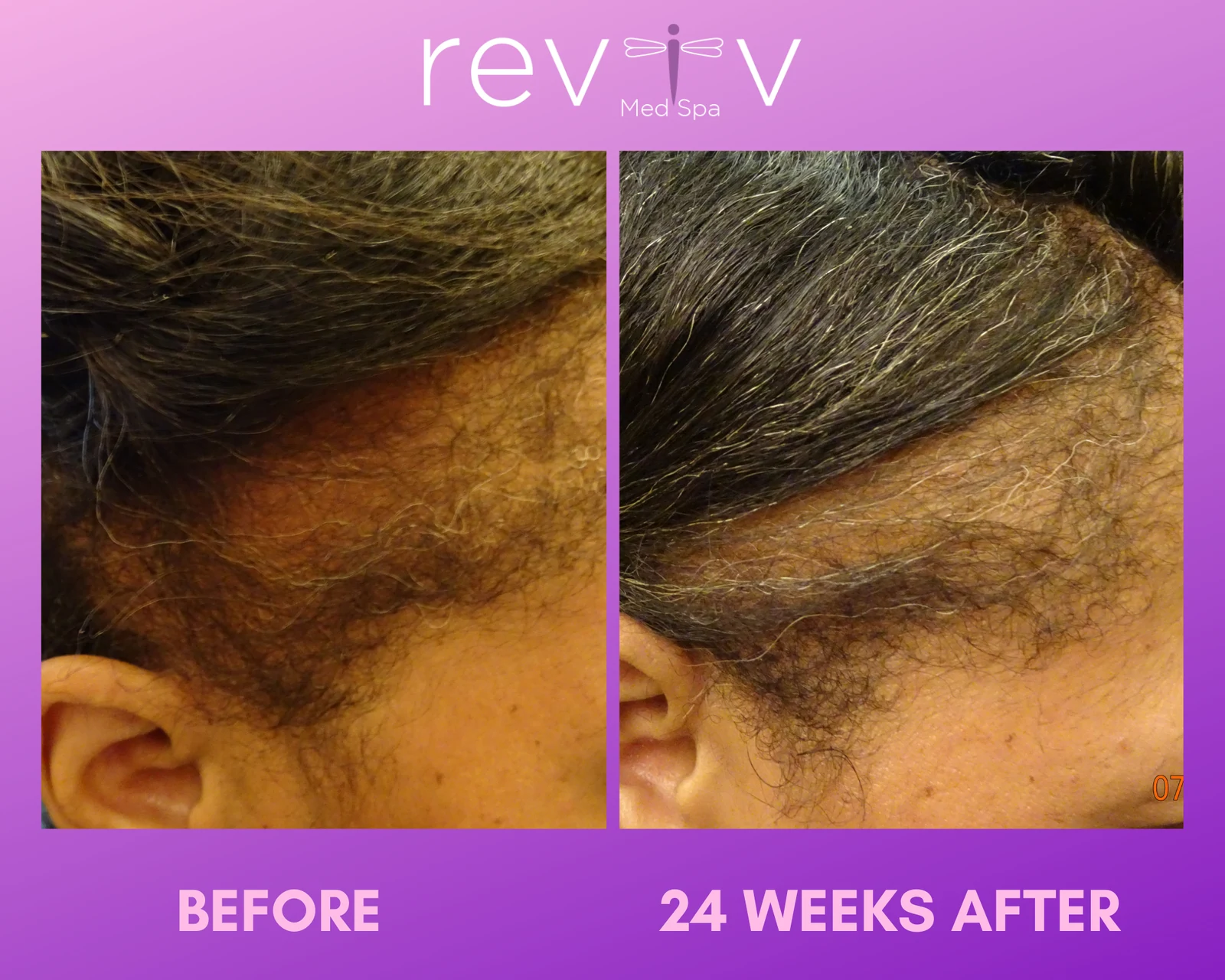 Reviv Med Spa patient before and after — PRP Hair, Millbrae, California
