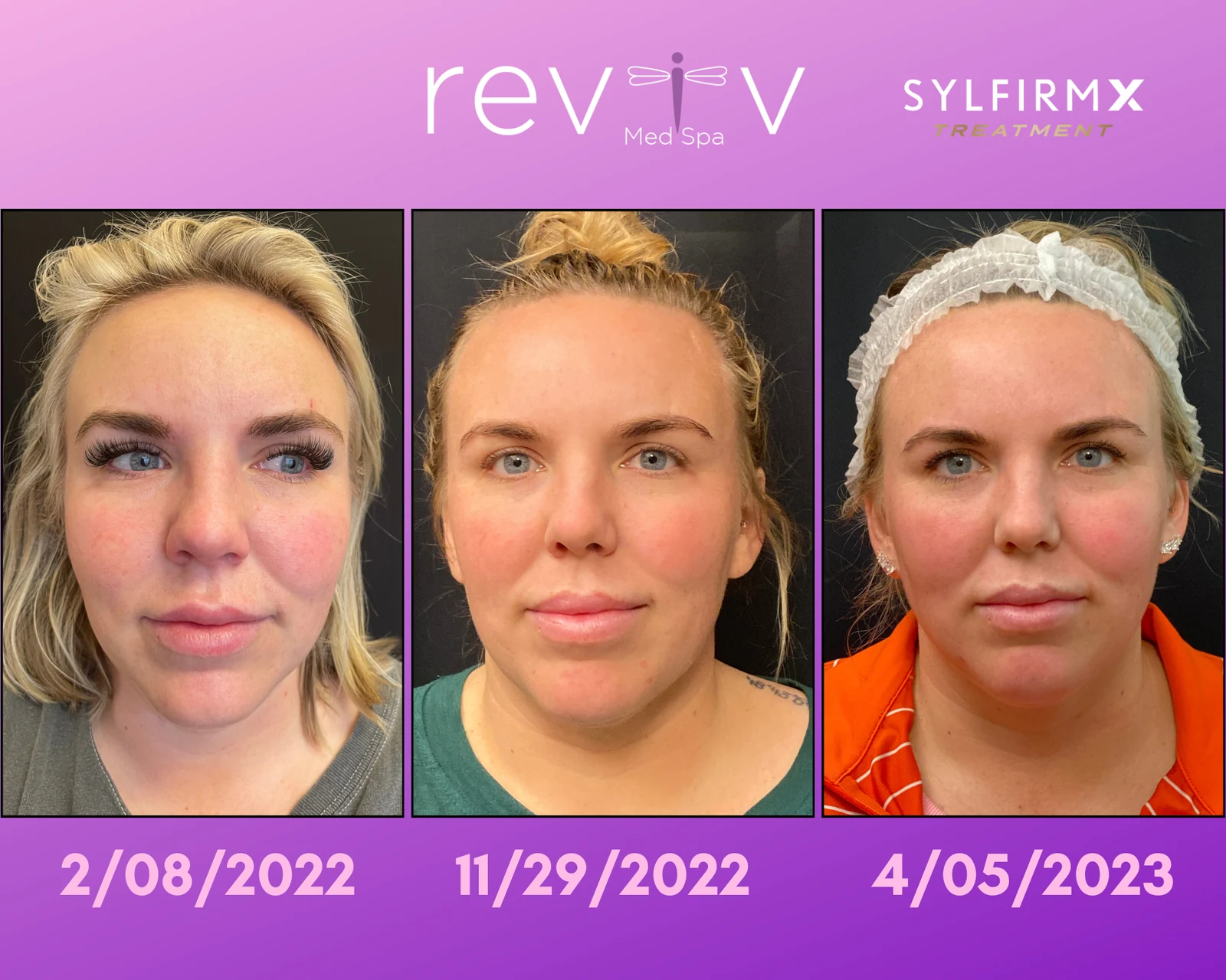 Reviv Med Spa patient before and after — Sylfirm X, Millbrae, California