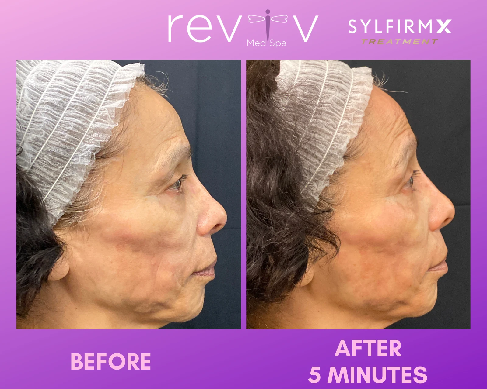 Reviv Med Spa patient before and after — Sylfirm X, Millbrae, California