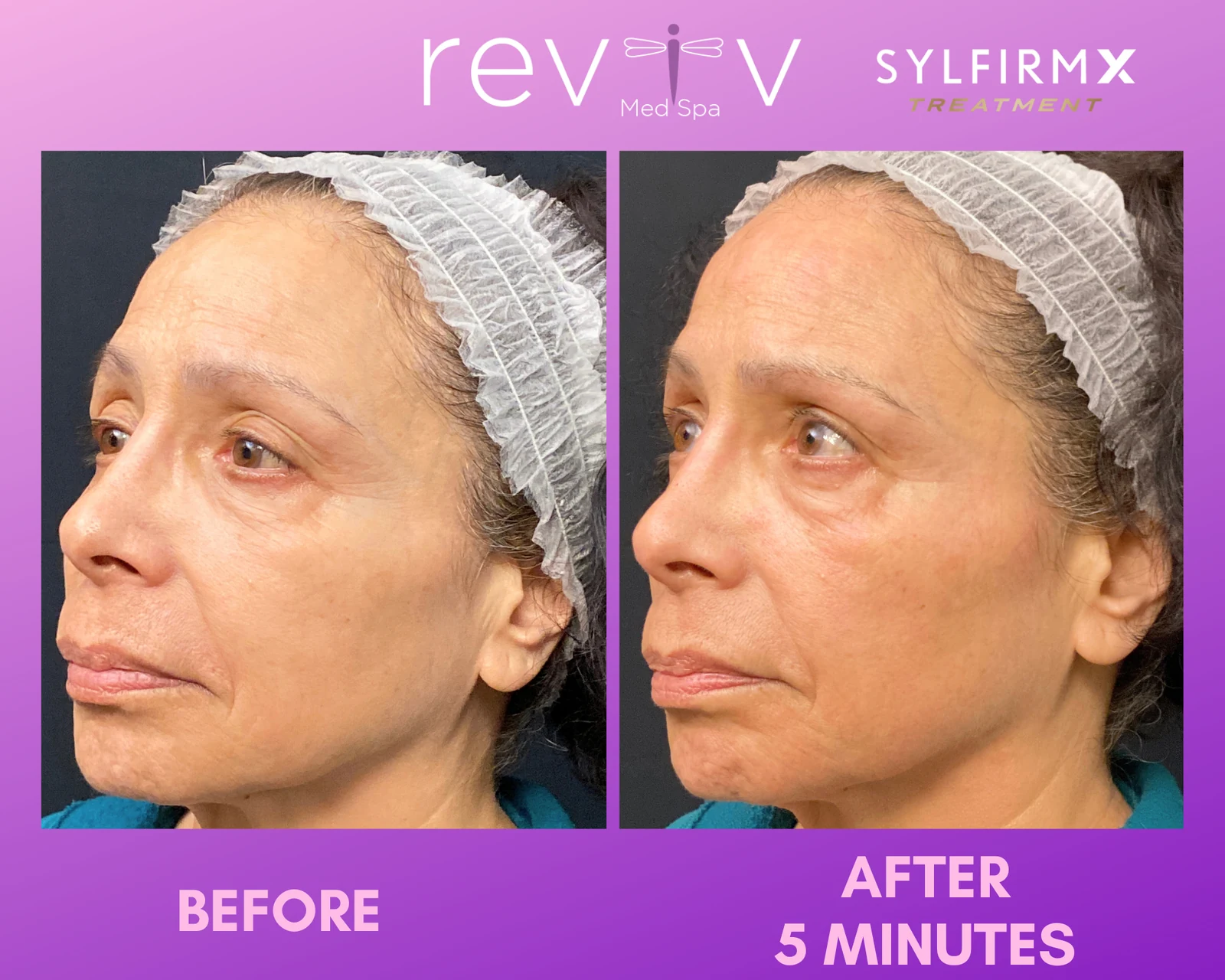 Reviv Med Spa patient before and after — Sylfirm X, Millbrae, California