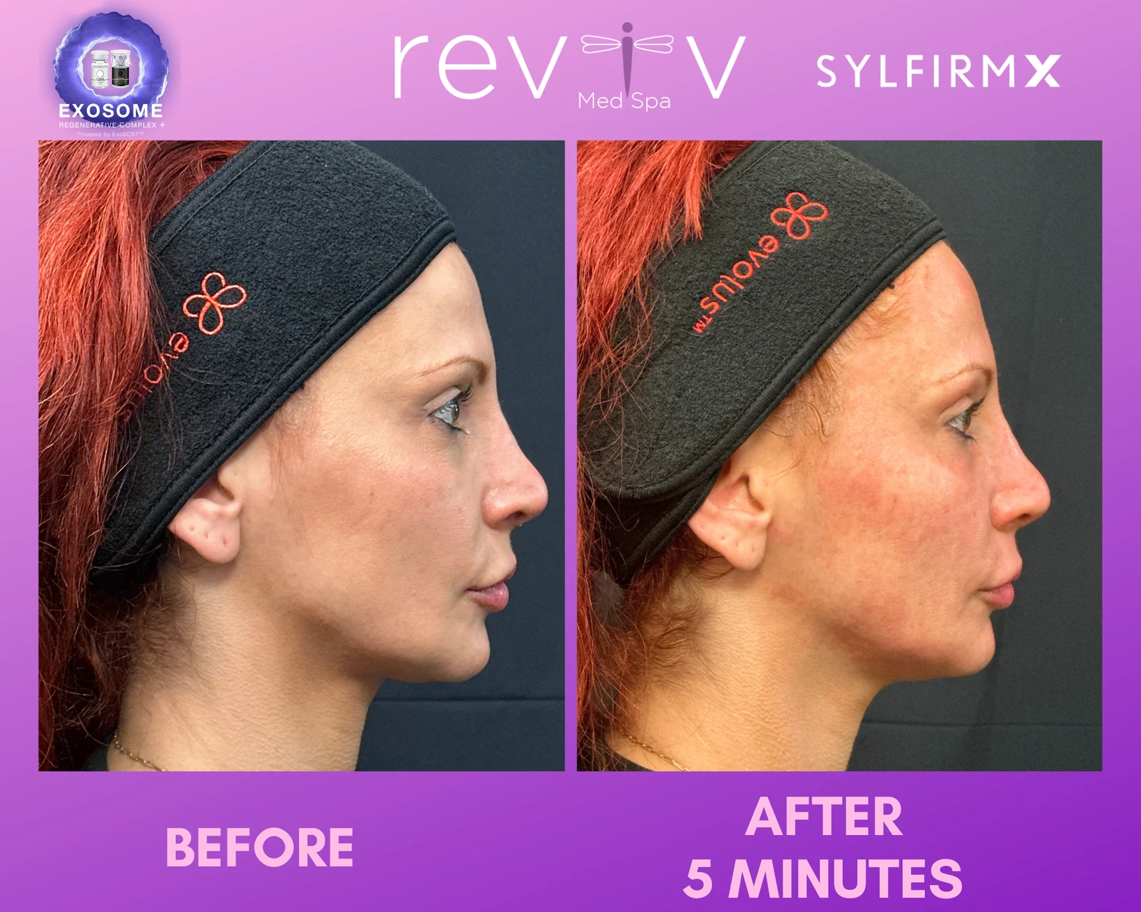 Reviv Med Spa patient before and after — Sylfirm X, Millbrae, California
