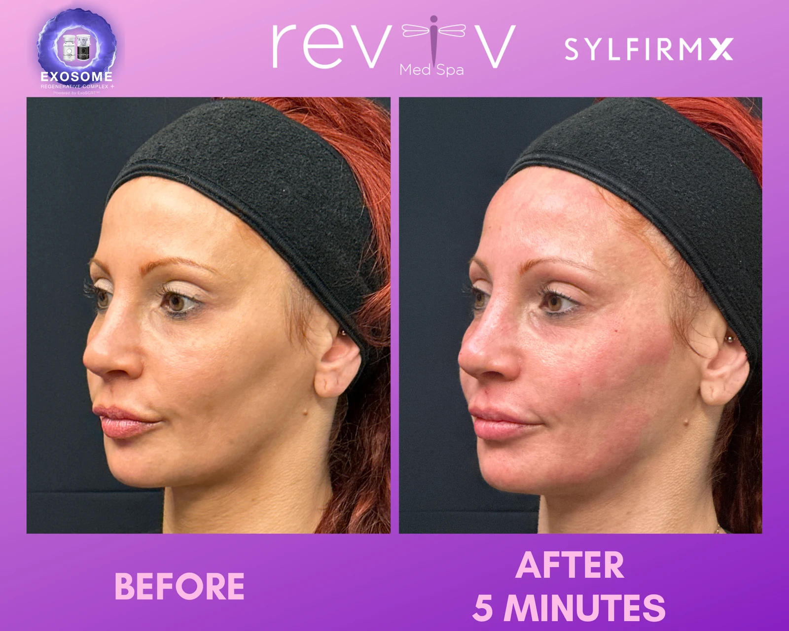 Reviv Med Spa patient before and after — Sylfirm X, Millbrae, California