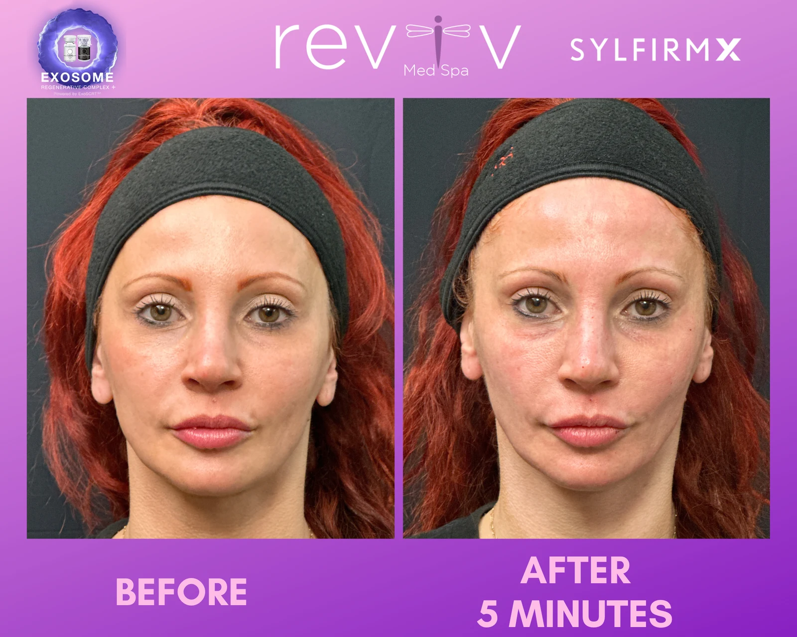 Reviv Med Spa patient before and after — Sylfirm X, Millbrae, California