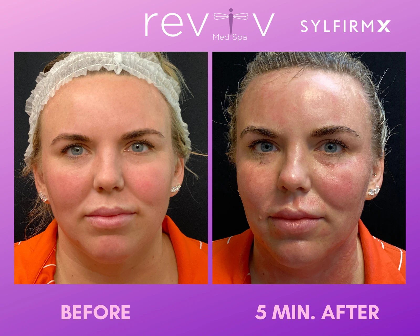 Reviv Med Spa patient before and after — Sylfirm X, Millbrae, California