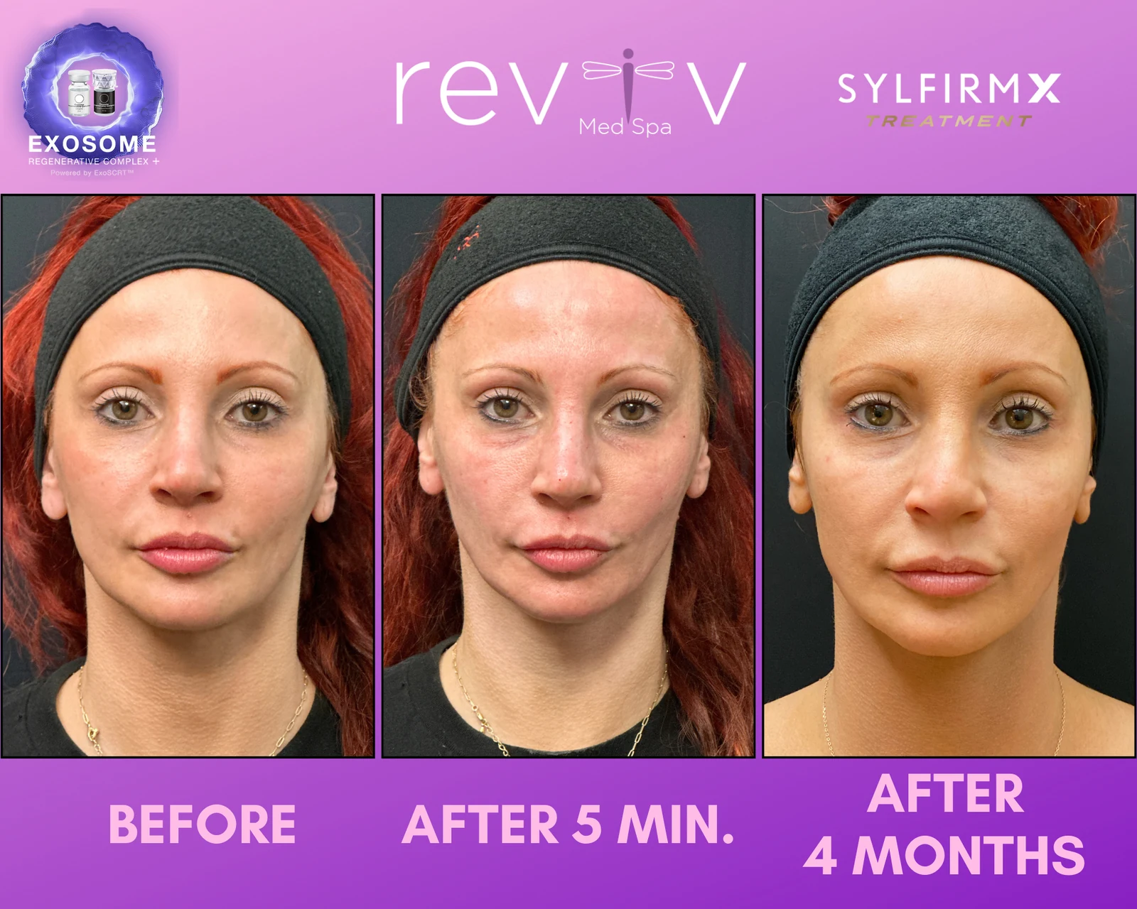 Reviv Med Spa patient before and after — Sylfirm X, Millbrae, California