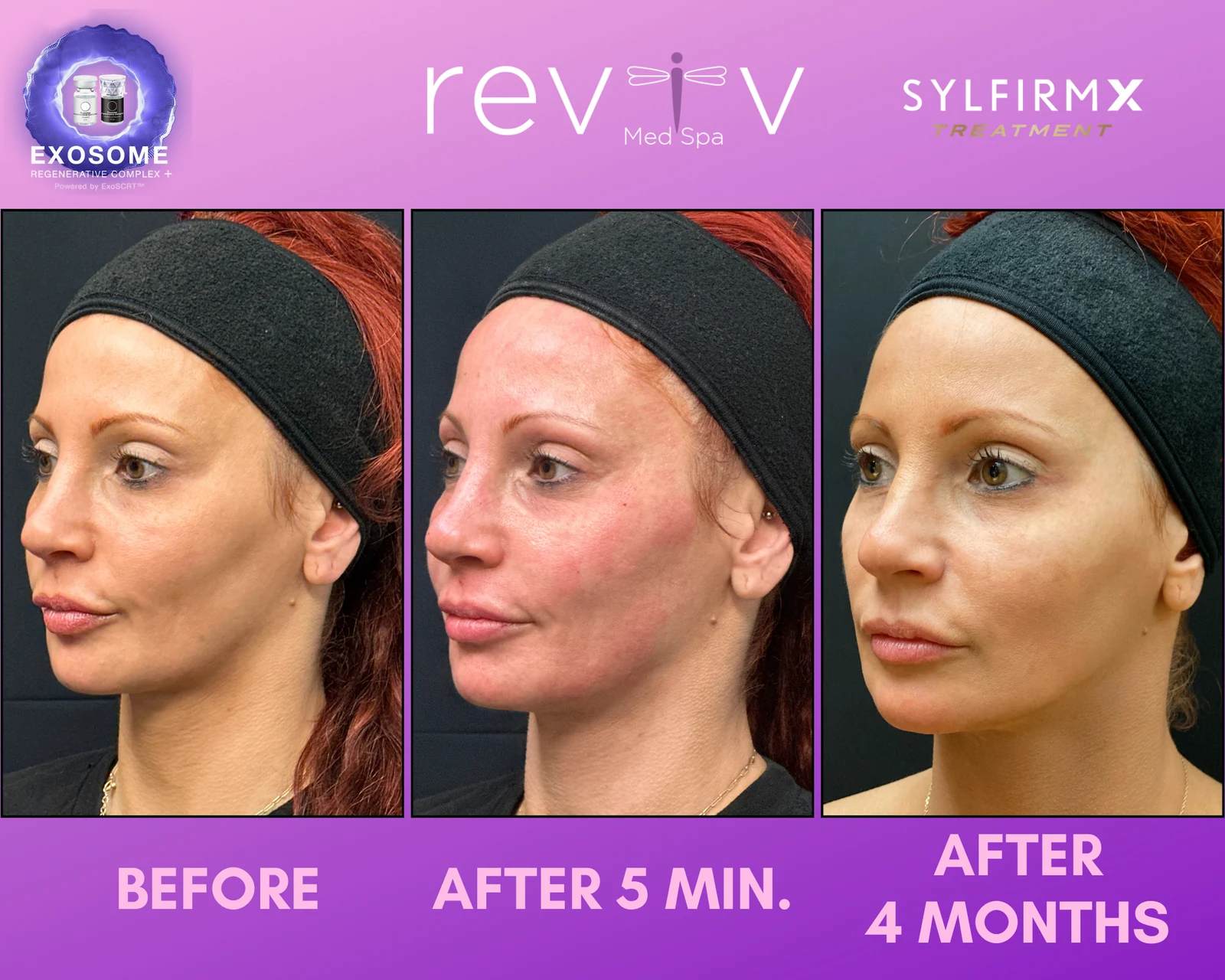 Reviv Med Spa patient before and after — Sylfirm X, Millbrae, California