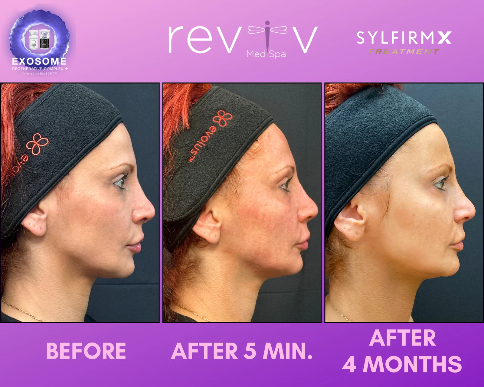 Reviv Med Spa patient before and after — Sylfirm X, Millbrae, California