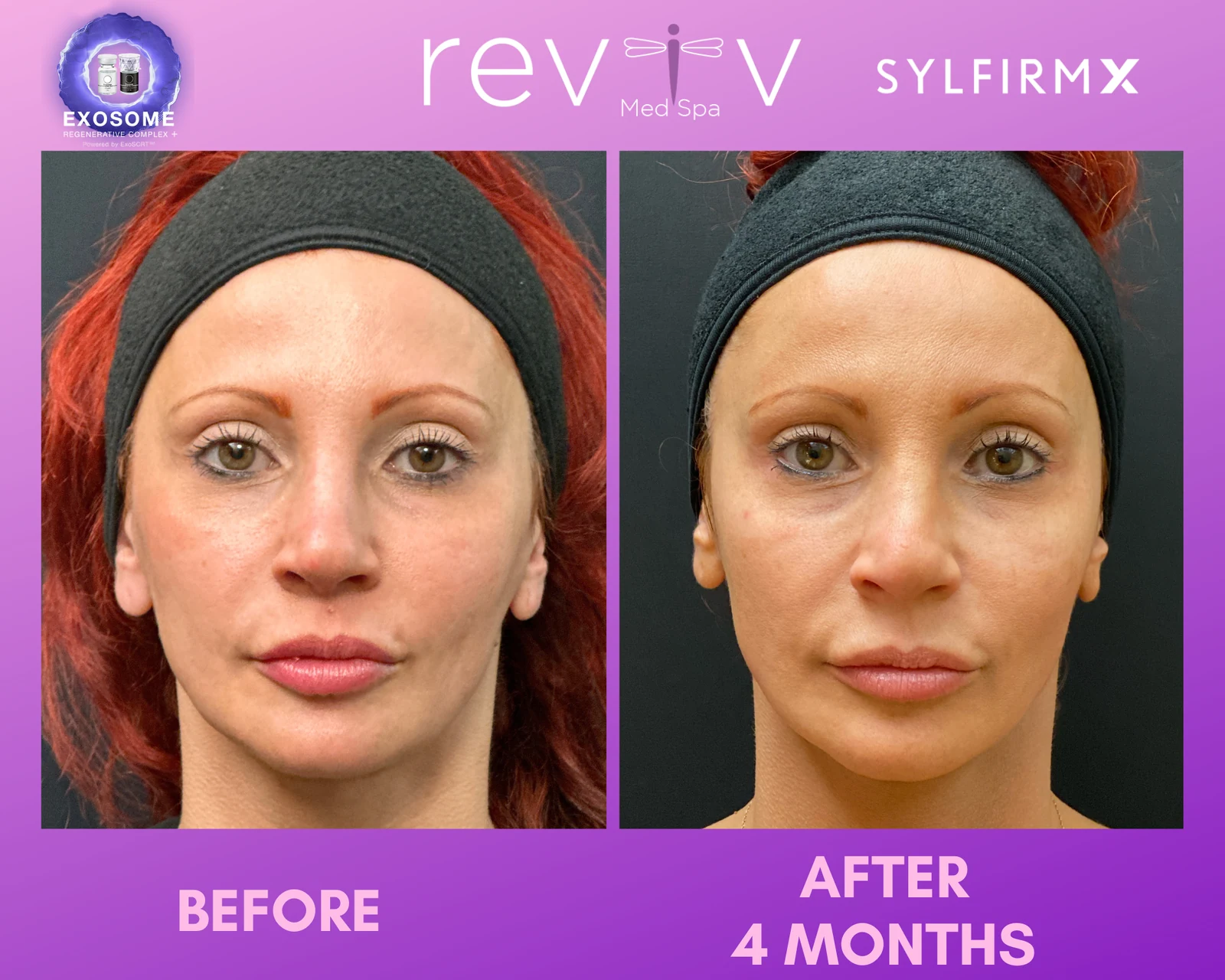 Reviv Med Spa patient before and after — Sylfirm X, Millbrae, California
