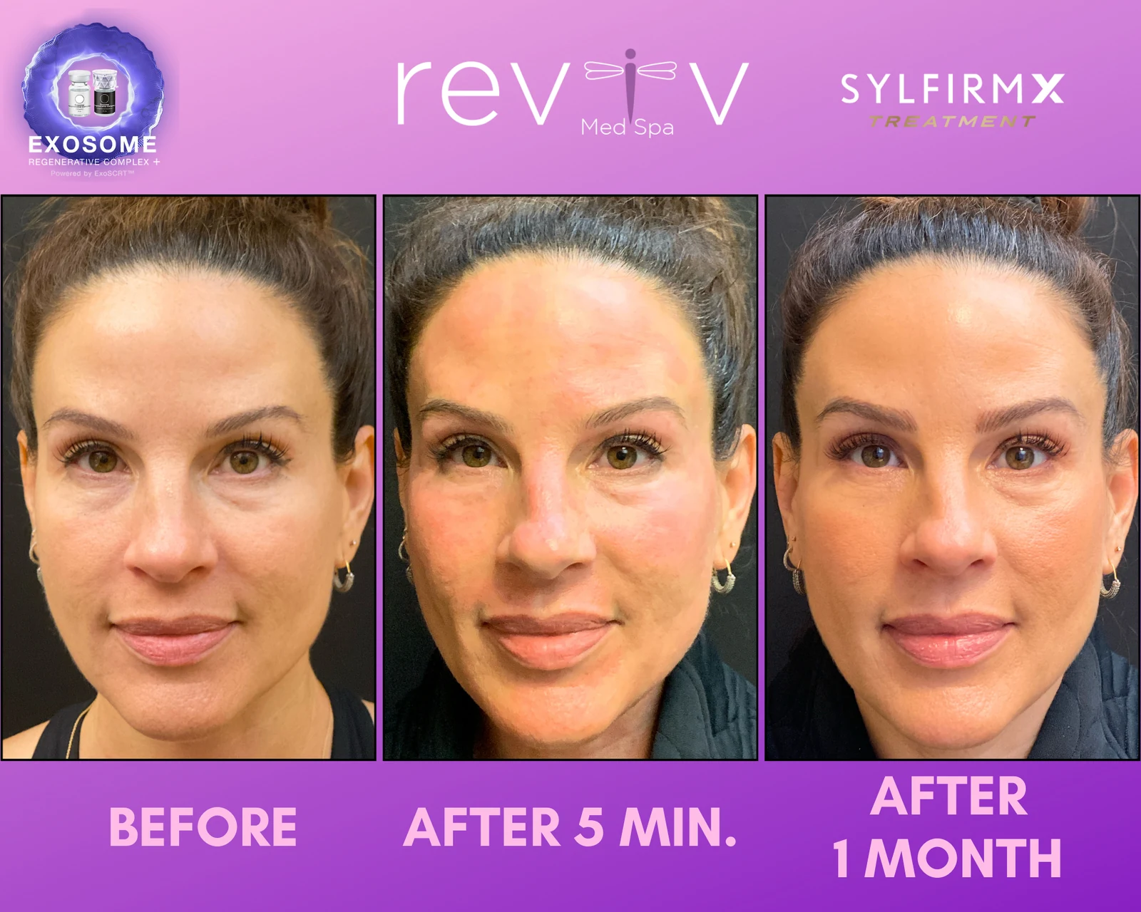 Reviv Med Spa patient before and after — Sylfirm X, Millbrae, California