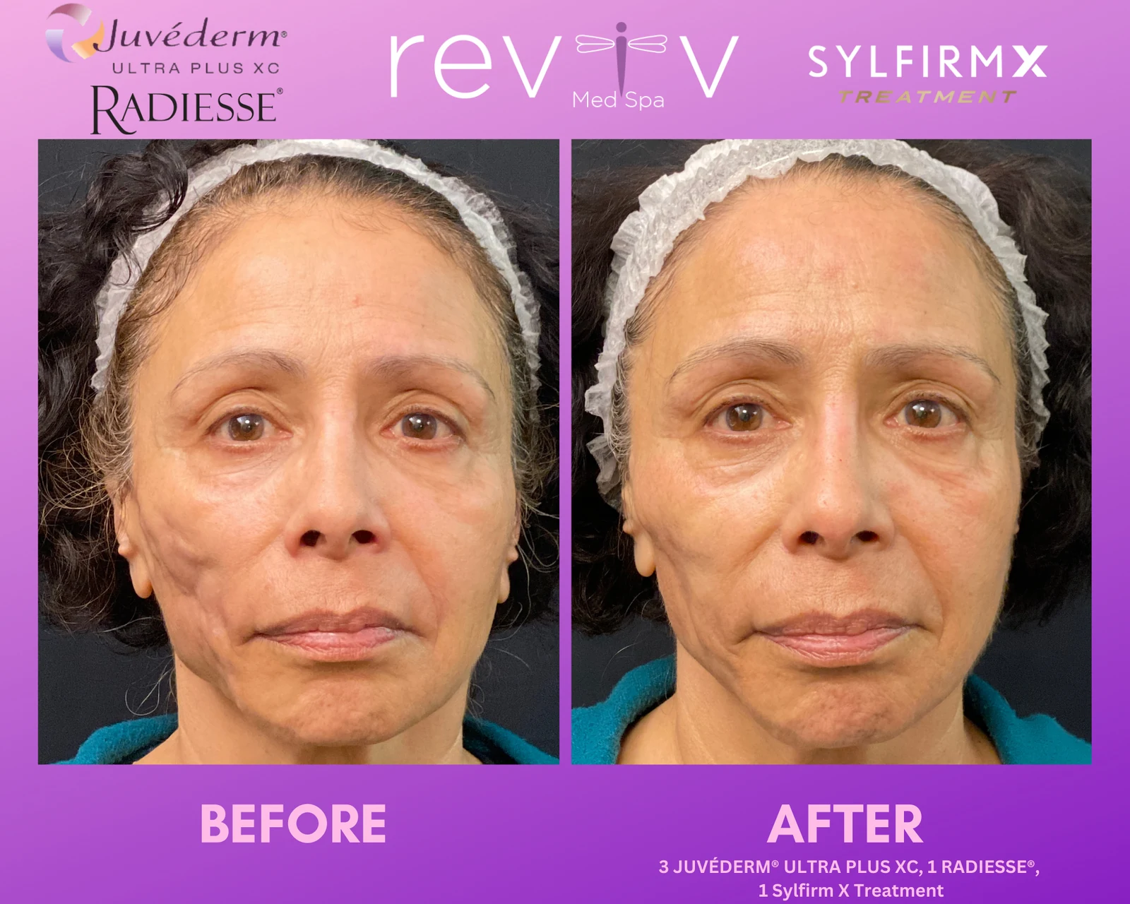Reviv Med Spa patient before and after — Sylfirm + Filler, Millbrae, California