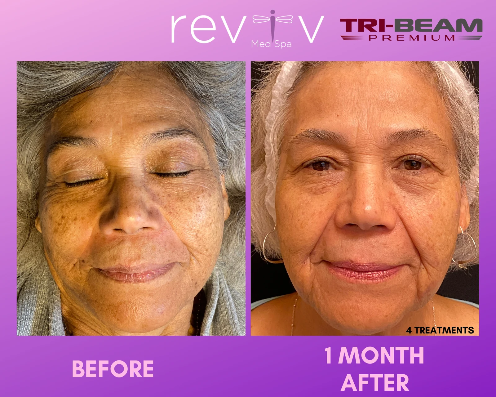 Reviv Med Spa patient before and after — TriBeam Pigment, Millbrae, California